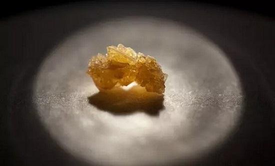 尿酸铵结石的分类