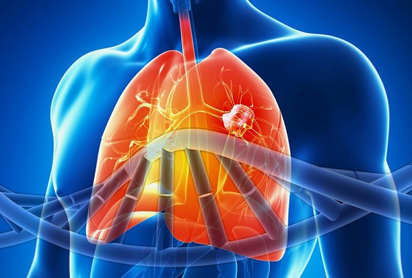 转移性非小细胞肺癌